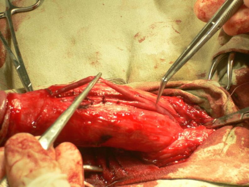 penis lipofilling for enlargement