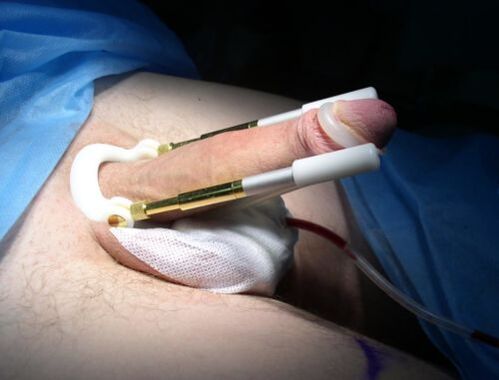 using an extender after penis enlargement surgery
