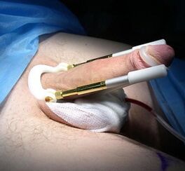 How penis enlargement surgery is performed